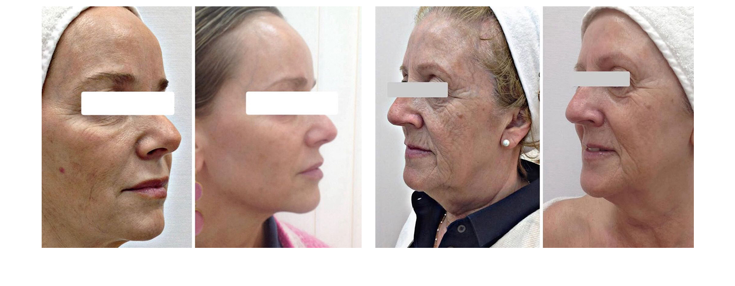 thermage-flx-3