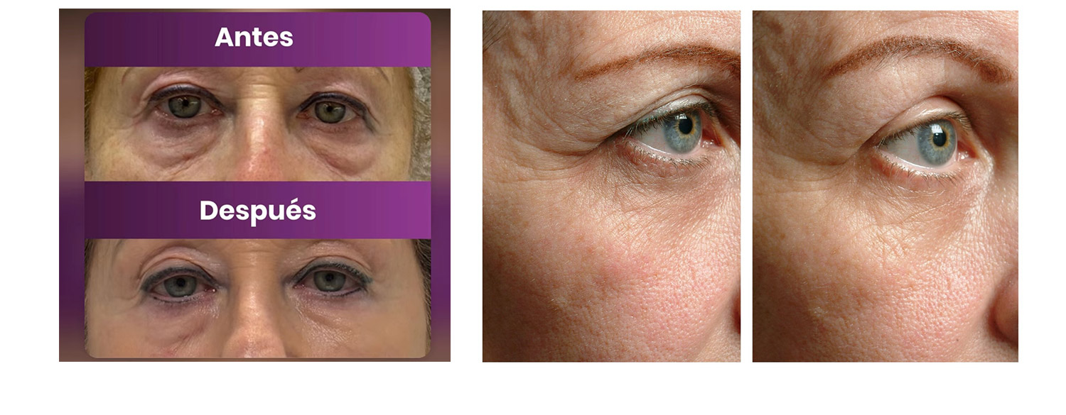 thermage-flx-3